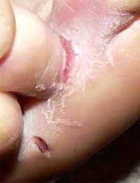 Antifungals Fungal Infection Pains Body